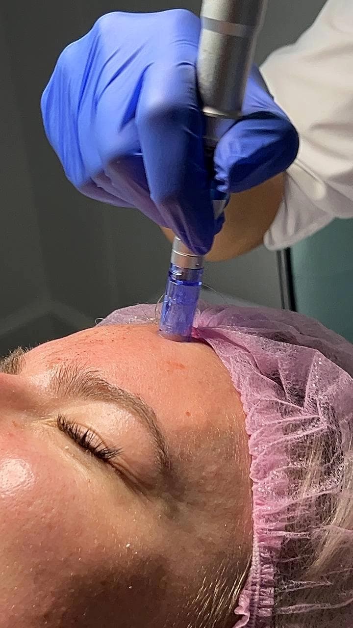 Microneedling (Face + Neck)