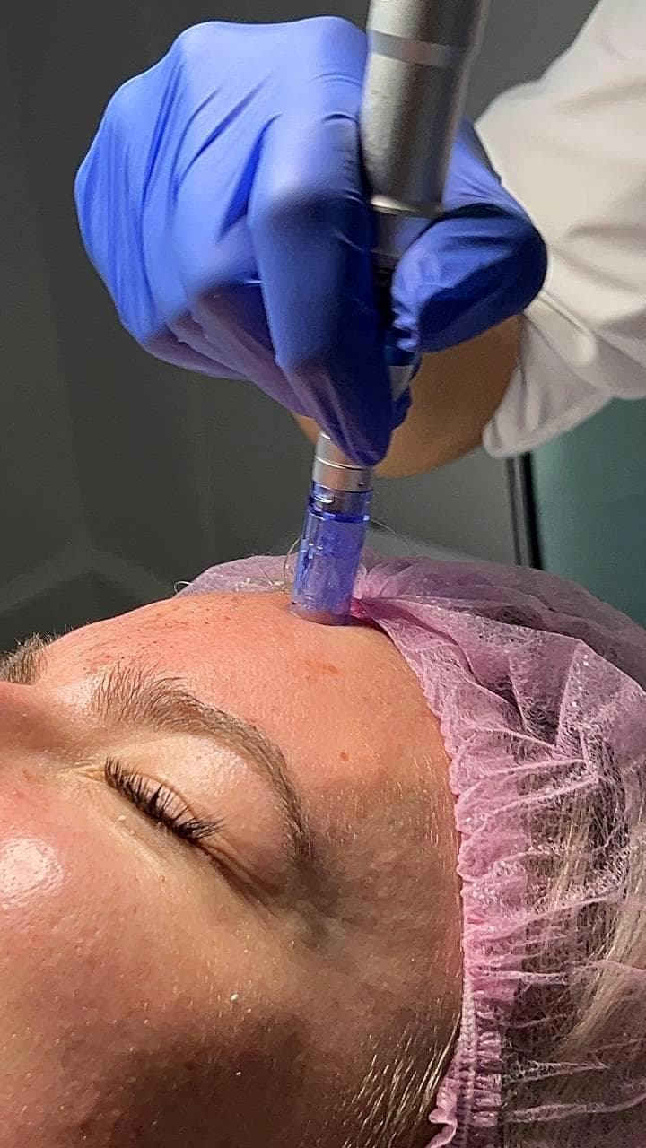 Microneedling (Face Only)